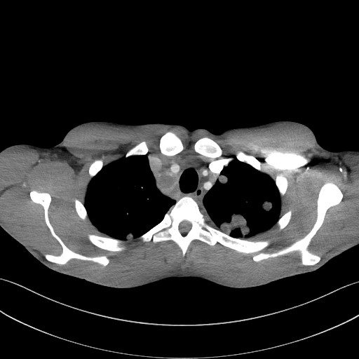 Cannonball metastases - testicular choriocarcinoma (Radiopaedia 84510-99891 B 29).jpg