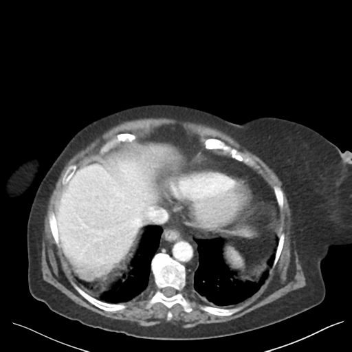 Cannonball metastases from endometrial cancer (Radiopaedia 42003-45031 E 12).png