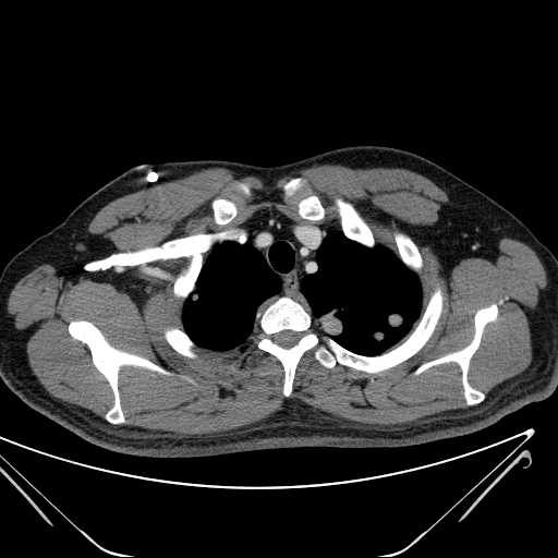 File:Cannonball pulmonary metastases (Radiopaedia 67684-77101 D 41).jpg