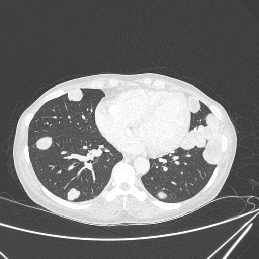 Canonball lung metastasis (Radiopaedia 77634-89837 Axial lung window 121).jpg