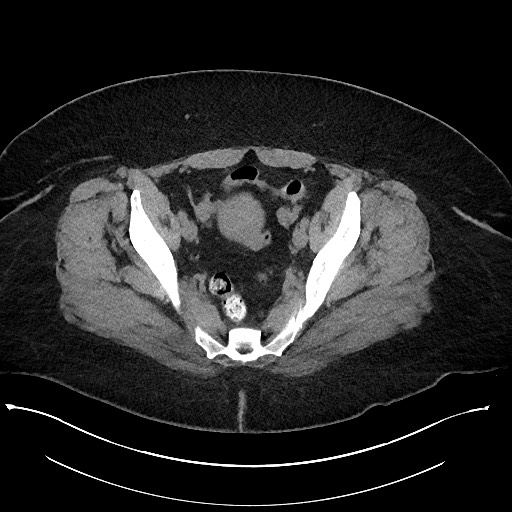 Carcinoid tumor - terminal ileum (Radiopaedia 60931-68740 Axial non-contrast 102).jpg