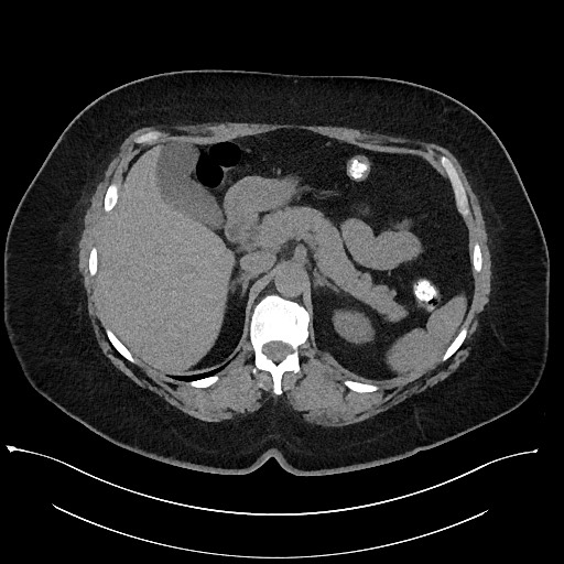 Carcinoid tumor - terminal ileum (Radiopaedia 60931-68740 Axial non-contrast 27).jpg