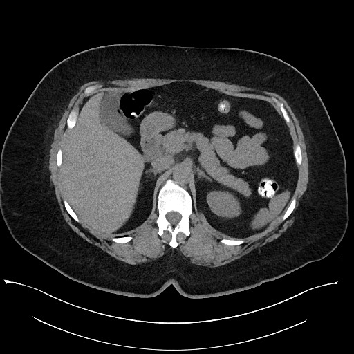 Carcinoid tumor - terminal ileum (Radiopaedia 60931-68740 Axial non-contrast 29).jpg