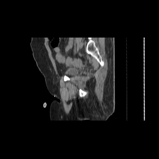 File:Carcinoma cervix- brachytherapy applicator (Radiopaedia 33135-34173 D 134).jpg