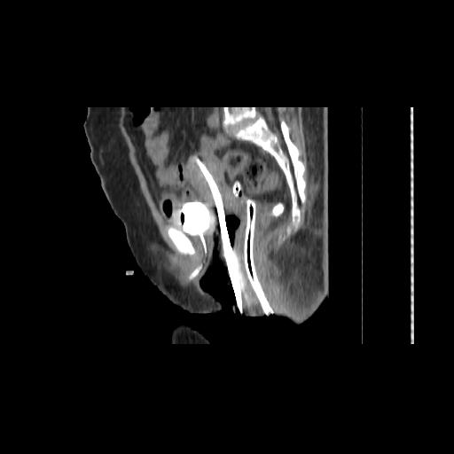 File:Carcinoma cervix- brachytherapy applicator (Radiopaedia 33135-34173 D 88).jpg