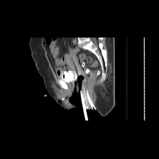 File:Carcinoma cervix- brachytherapy applicator (Radiopaedia 33135-34173 D 93).jpg