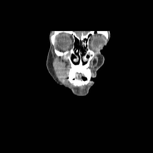 Carcinoma of the maxillary antrum (Radiopaedia 53805-59888 Coronal C+ delayed 18).jpg