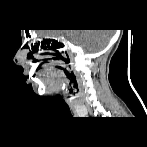 Carcinoma of the maxillary antrum (Radiopaedia 53805-59888 Sagittal C+ delayed 107).jpg