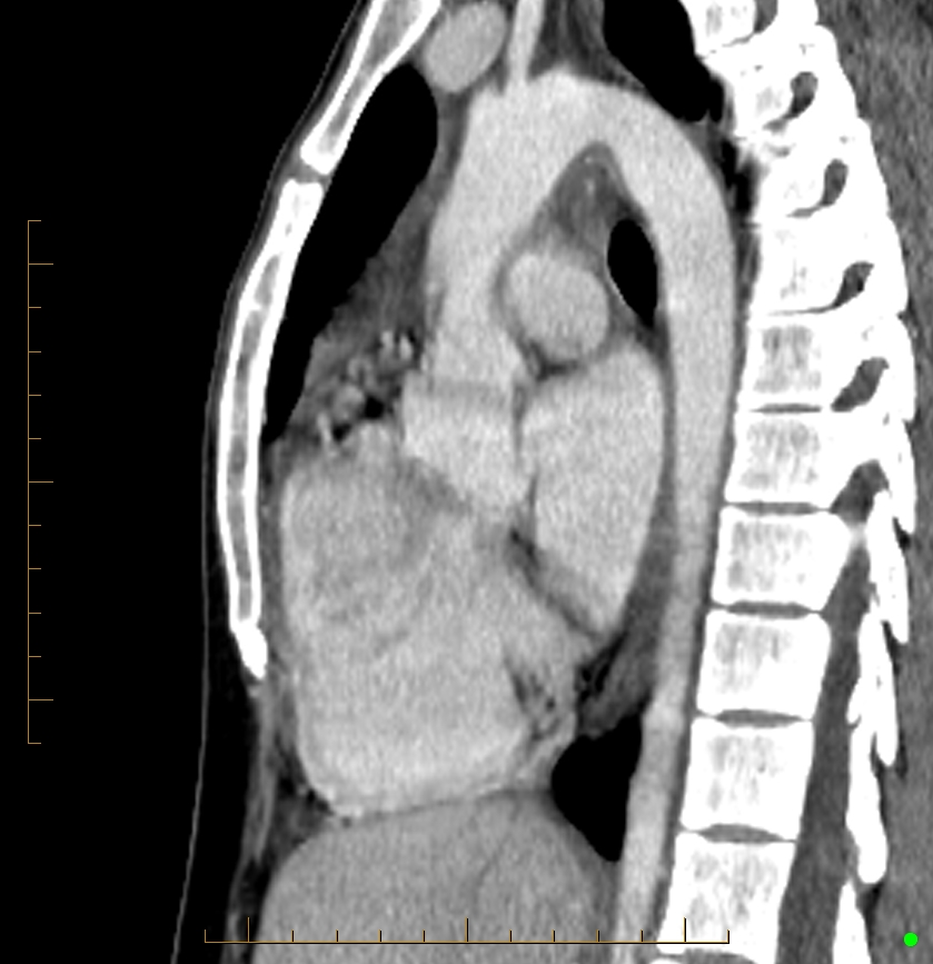 Cardiac paraganglioma (Radiopaedia 76345-88005 C 55).jpg