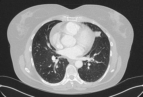 Cardiac sarcoidosis (Radiopaedia 74548-85534 Axial lung window 47).jpg