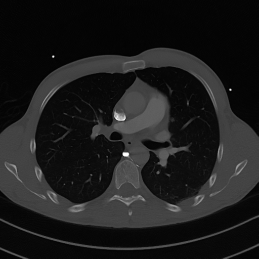 Cardiac tumor - undifferentiated pleomorphic sarcoma (Radiopaedia 45844-50134 Axial bone window 30).png