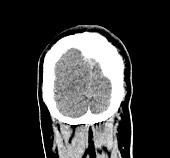 File:Cardioembolic stroke- ACA and MCA territories (Radiopaedia 58904-66140 Coronal non-contrast 139).jpg