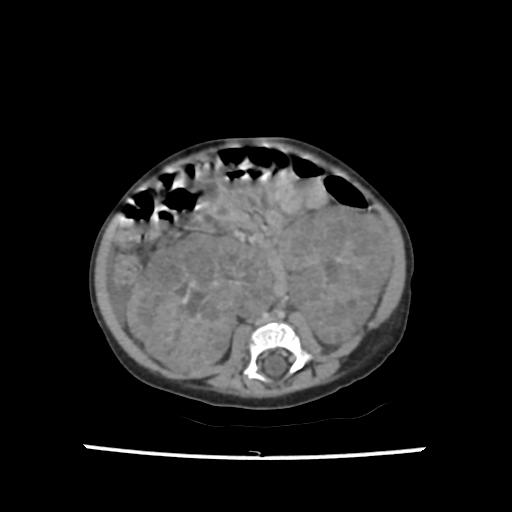 File:Caroli disease with autosomal recessive polycystic kidney disease (ARPKD) (Radiopaedia 89651-106703 B 138).jpg