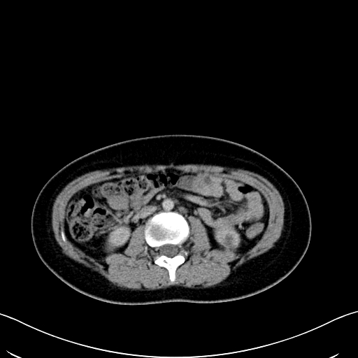 Caroli disease with medullary sponge kidney (Radiopaedia 82622-96804 C 36).jpg