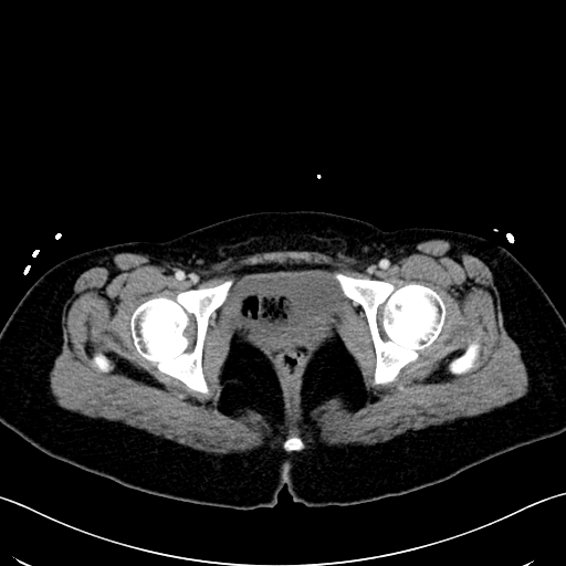 Caroli disease with medullary sponge kidney (Radiopaedia 82622-96804 C 74).jpg