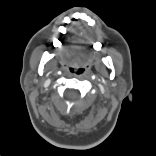 File:Carotico ophthalmic aneurysm (Radiopaedia 42916-46148 A 56).png