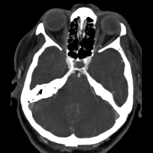 File:Carotico ophthalmic aneurysm (Radiopaedia 42916-46148 C 2).png