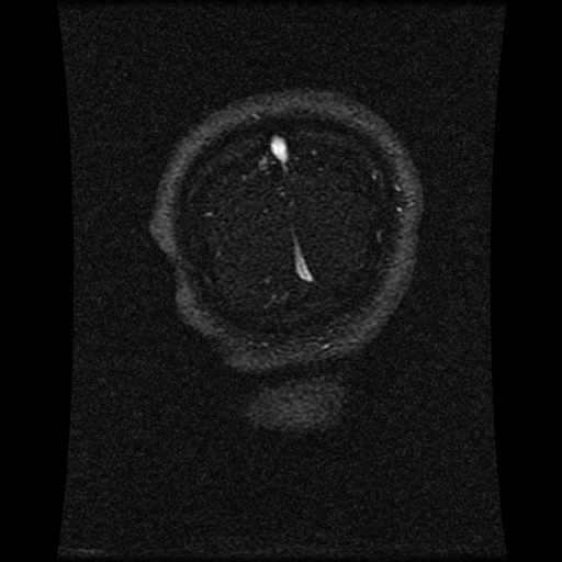 Carotid arterial dissection with acute cerebral infarction (Radiopaedia 26636-26784 MRV 36).jpg