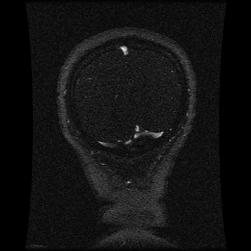 Carotid arterial dissection with acute cerebral infarction (Radiopaedia 26636-26784 MRV 46).jpg