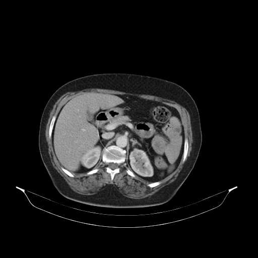 File:Carotid body tumor (Radiopaedia 21021-20948 B 67).jpg