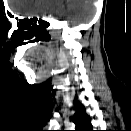 File:Carotid body tumor (Radiopaedia 27890-28124 C 14).jpg