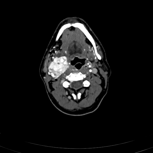 File:Carotid body tumor (Radiopaedia 83615-98727 A 54).jpg