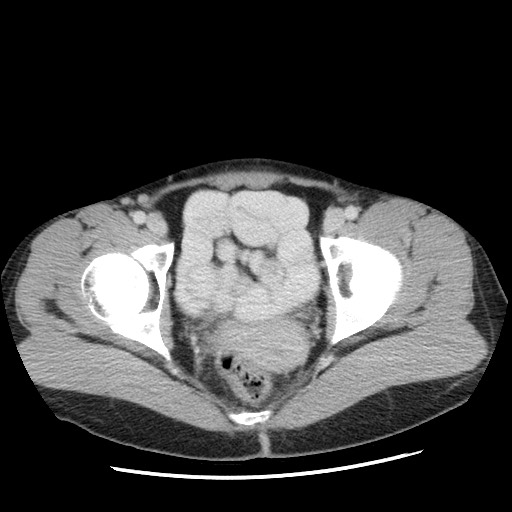 Castleman disease with fibrous pseudotumor in the abdomen (Radiopaedia 77296-89373 A 118).jpg