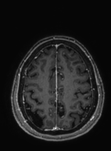 Cavernous hemangioma of the cerebellar falx (Radiopaedia 73025-83724 Axial T1 C+ 84).jpg