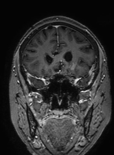 Cavernous hemangioma of the cerebellar falx (Radiopaedia 73025-83724 Coronal T1 C+ 119).jpg