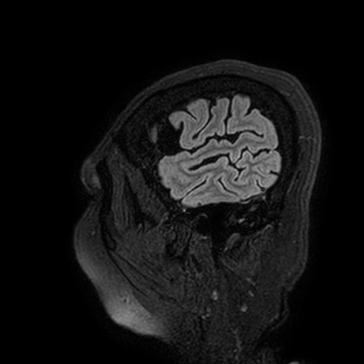 Cavernous hemangioma of the cerebellar falx (Radiopaedia 73025-83724 Sagittal FLAIR 15).jpg