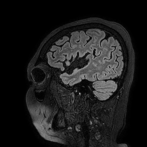 Cavernous hemangioma of the cerebellar falx (Radiopaedia 73025-83724 Sagittal FLAIR 36).jpg