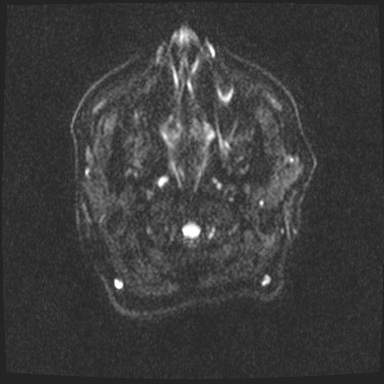 Cavernous sinus meningioma (Radiopaedia 63682-72367 DWI 21).jpg