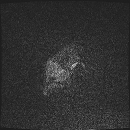 Cavernous sinus meningioma (Radiopaedia 63682-72367 Sagittal T1 C+ 8).jpg