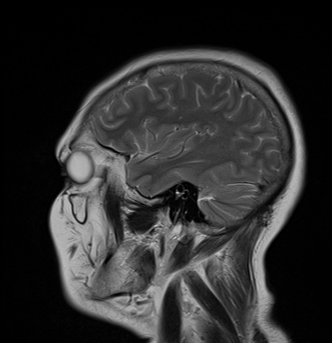 File:Cavernous sinus meningioma (Radiopaedia 63682-72367 Sagittal T2 16).jpg
