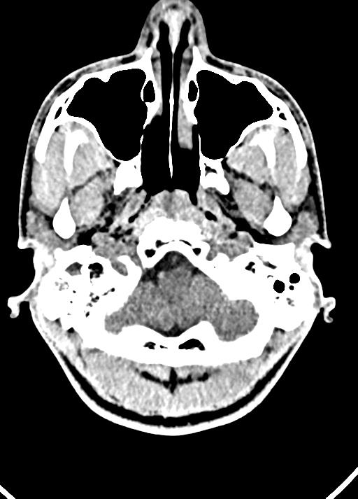 Cavum septum pellucidum and cavum vergae (Radiopaedia 77797-90060 Axial Brain Window 13).jpg