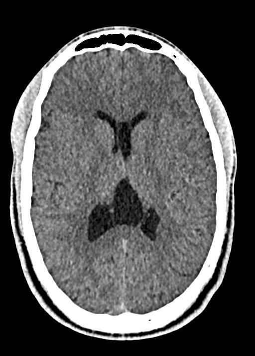 Cavum septum pellucidum and cavum vergae (Radiopaedia 77797-90060 Axial Brain Window 58).jpg
