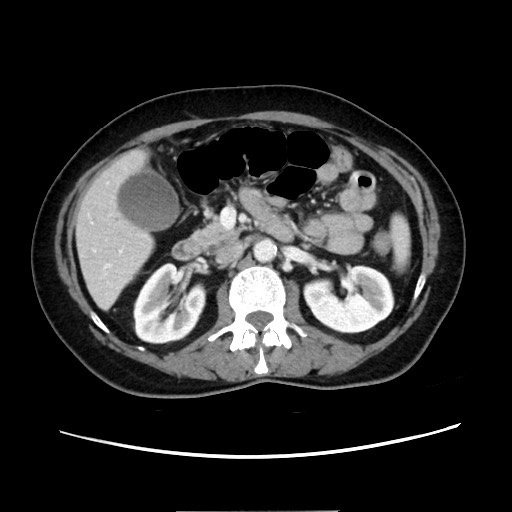 Cecal adenocarcinoma (Radiopaedia 75909-87331 A 37).jpg
