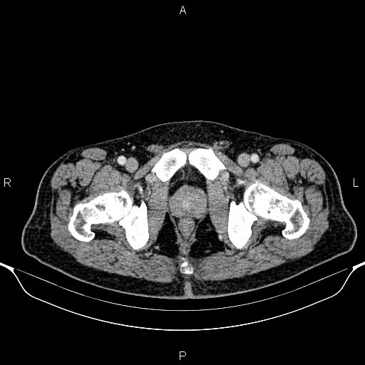 Cecal adenocarcinoma (Radiopaedia 85324-100916 B 100).jpg