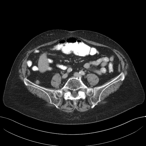 Cecal adenocarcinoma - surgical scar recurrence (Radiopaedia 79988-93264 C 46).jpg