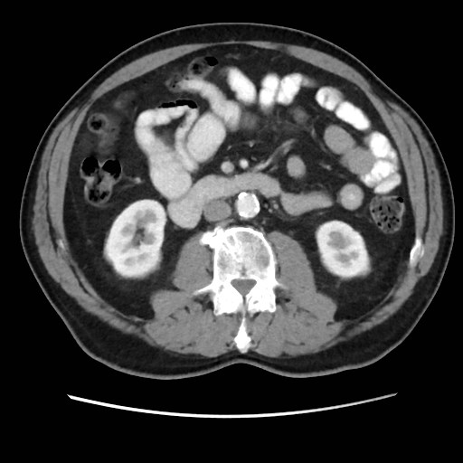 Cecal mass causing appendicitis (Radiopaedia 59207-66531 A 42).jpg