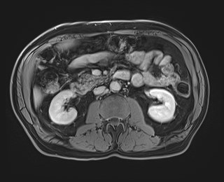 Cecal mass causing appendicitis (Radiopaedia 59207-66532 J 64).jpg