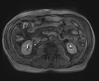 File:Cecal mass causing appendicitis (Radiopaedia 59207-66532 K 67).jpg