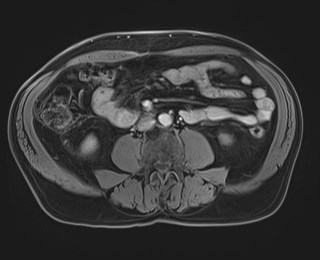 Cecal mass causing appendicitis (Radiopaedia 59207-66532 T1 C+ PV phase 78).jpg