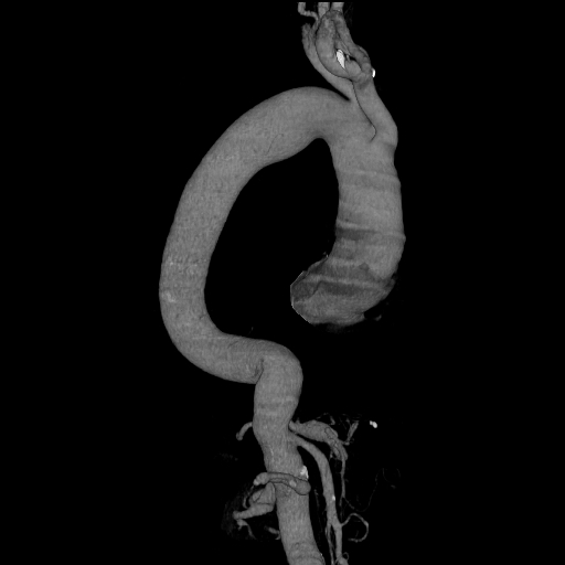 File:Celiac artery aneurysm (Radiopaedia 21574-21525 C 14).JPEG