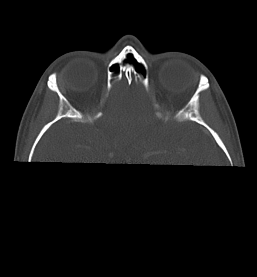 Cemento-ossifying fibroma (Radiopaedia 46243-50643 Axial bone window 15).png