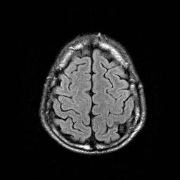 File:Central-variant posterior reversible encephalopathy syndrome (PRES) (Radiopaedia 43880-47359 Axial FLAIR 20).jpg