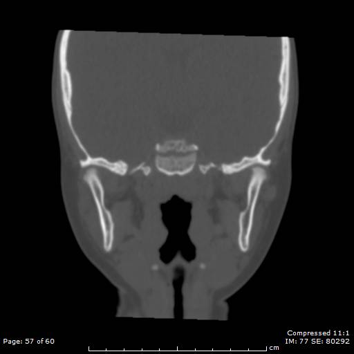 File:Central giant cell granuloma (Radiopaedia 45612-49754 Coronal bone window 57).jpg