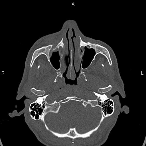 Central giant cell granuloma (Radiopaedia 83346-97761 Axial bone window 40).jpg