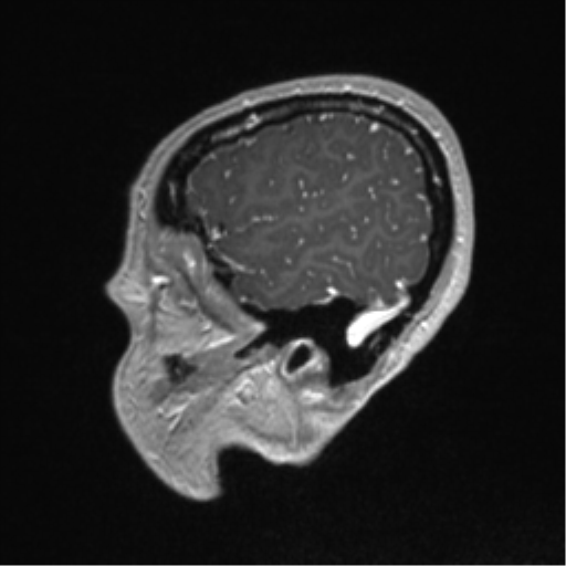 Central neurocytoma (Radiopaedia 37664-39557 Sagittal T1 C+ 82).png