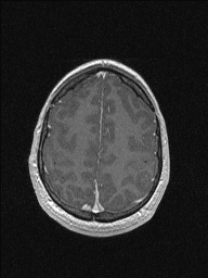 Central neurocytoma (Radiopaedia 56690-63469 Axial T1 C+ 135).jpg